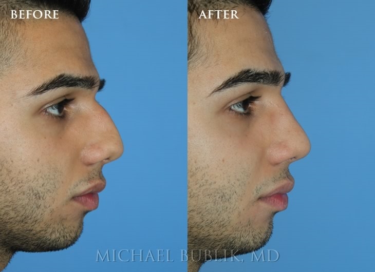 rhinoplasty experts